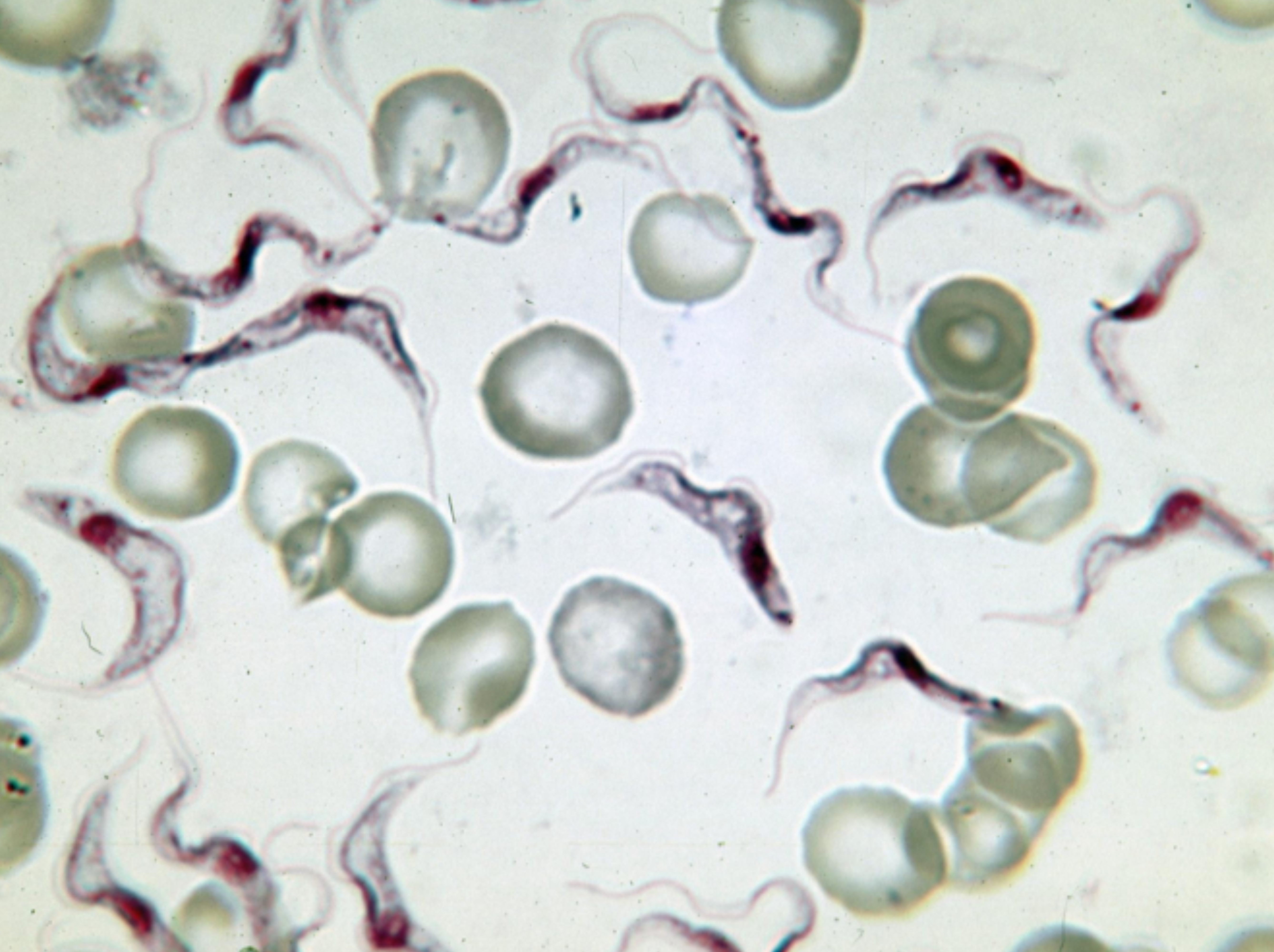 African Trypanosomiasis
