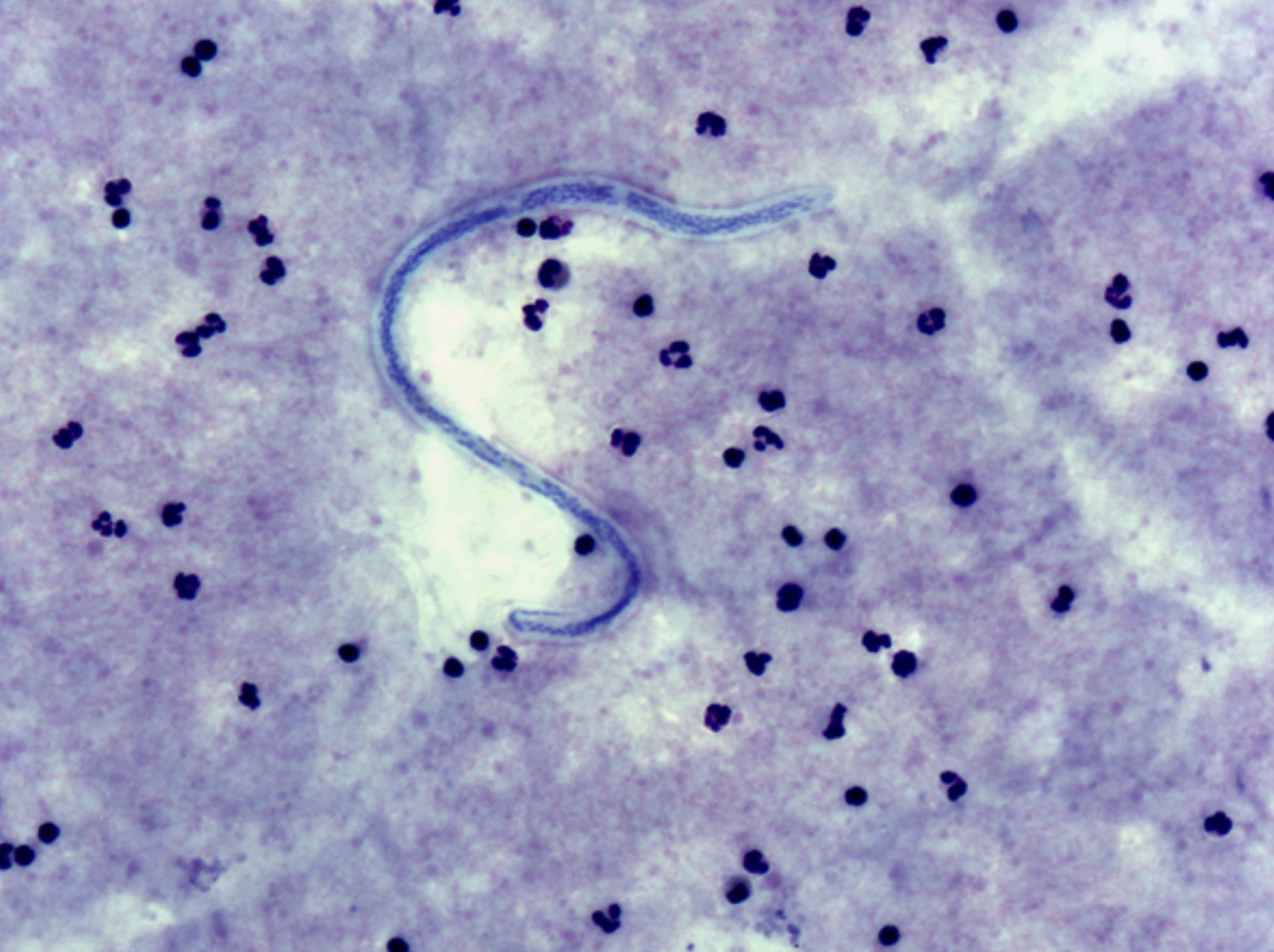 filariasis