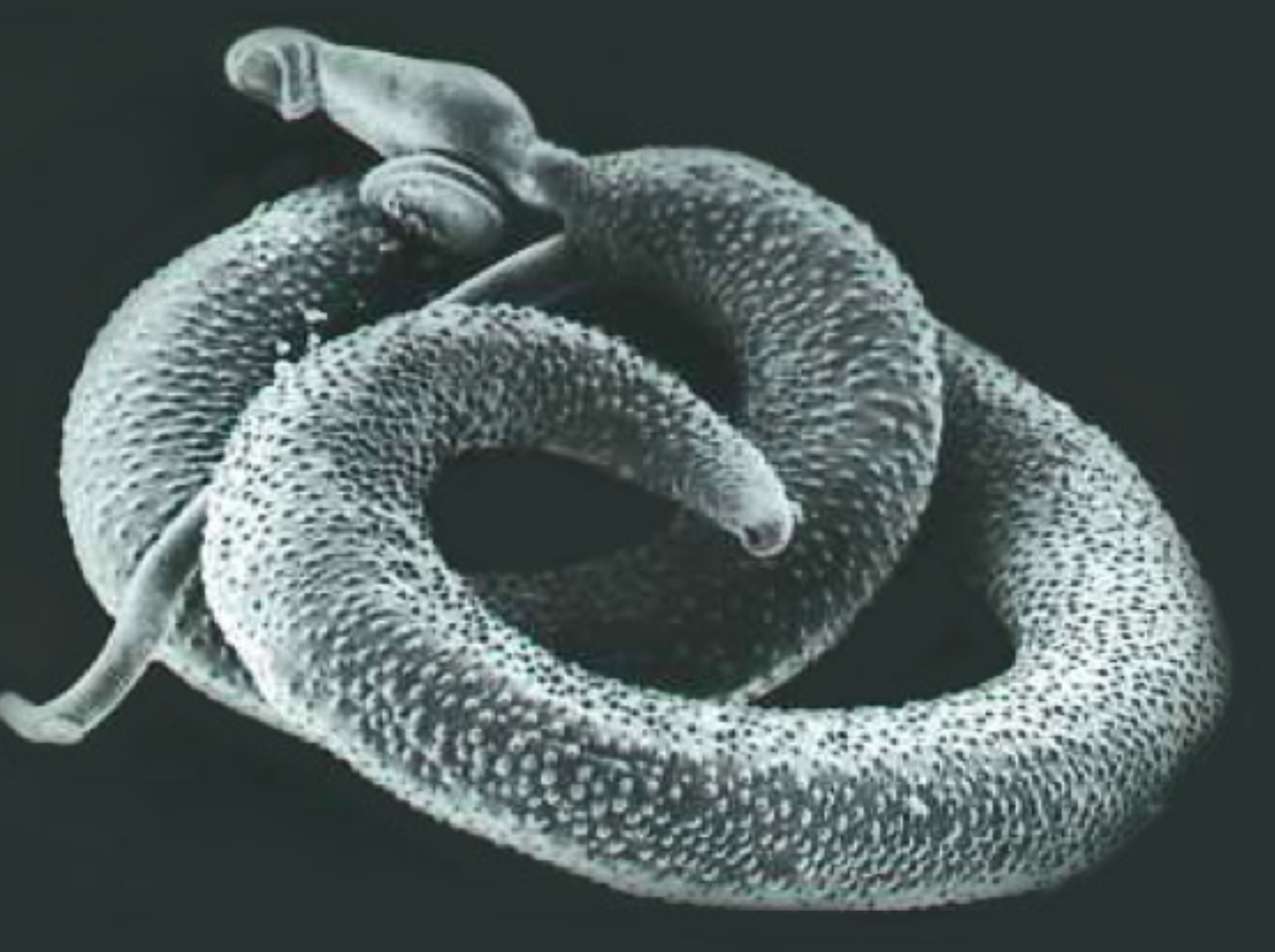 Schistosomiasis