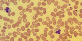 Plasmodium falciparum and Plasmodium vivax